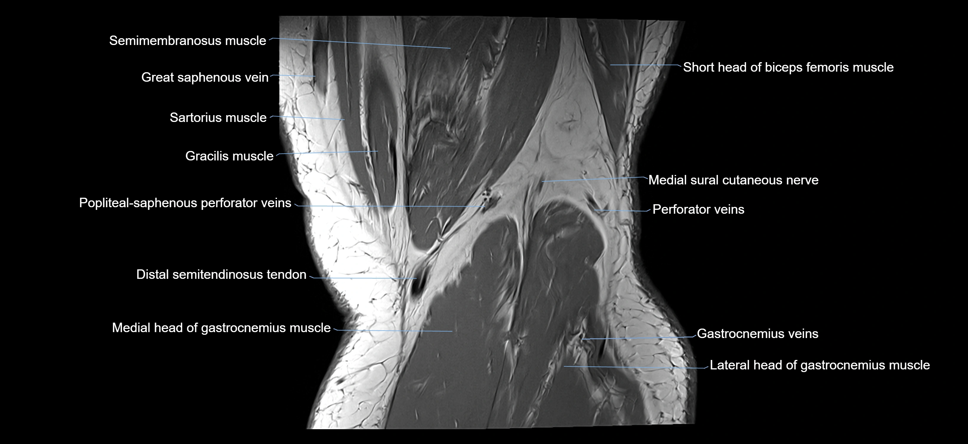 MRI knee coronal cross sectional anatomy labelled 3T radiology  image-04001-00039.webp